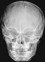 Skull: Anteroposterior Radiograph