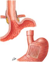 Esophagogastric Junction