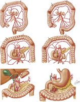 Variations in Colic Arteries - Part II