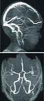 Cranial Imaging (MRV and MRA)