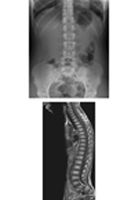 Vertebrae:  Radiology