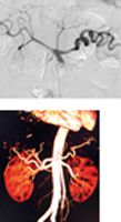 Celiac Arteriogram and CT Angiogram