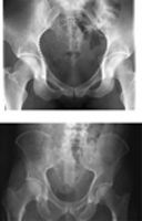 Radiographs of Male and Female Pelvis