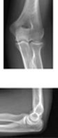 Elbow: Radiographs