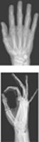 Wrist and Hand: Radiographs