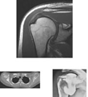 Shoulder MRI, CT Scan, and Arthrogram