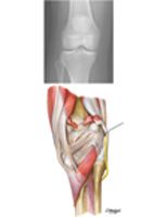 Knee:  Anteroposterior Radiograph and Posterior View