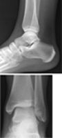 Ankle: Radiographs