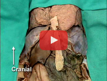 Anterior Abdominal Wall and Abdominal Viscera in situ: Step 11. Ligaments of the liver  