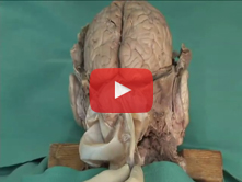 Cranial Cavity and Dural Venous Sinuses: Step 10. Reflection of the tentorium cerebelli and removal 