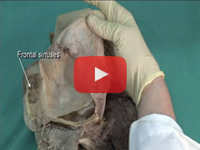 Cranial Cavity and Dural Venous Sinuses: Step 11. Dural venous sinuses  
