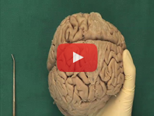 Brain: Step 1. Cerebral hemispheres, lobes, fissures, gyri and sulci
