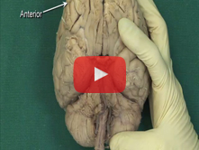 Brain: Step 3. Mesencephalon: cerebral peduncles, interpeduncular fossa, oculomotor nerve, trochlear