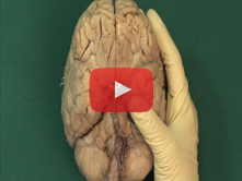 Brain: Step 4. Metencephalon: pons and cerebellum and associated cranial nerves