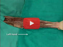 Flexor Surface of the Forearm: Step 4. Pronator teres and muscular branches of the median nerve  