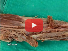 Flexor Surface of the Forearm: Step 5. Sectioning of first layer of flexor muscles  