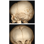 3D Skull Reconstruction CTs