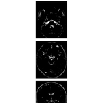 Axial and Coronal MRIs of Brain