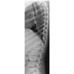 Thoracolumbar Spine: Lateral Radiograph