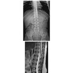Vertebrae: Radiograph and MRI