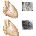 Coronary Arteries: Right Anterior Oblique Views with Arteriograms