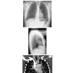Heart: Radiographs and CT Angiogram