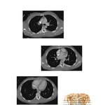 Chest Scans: Axial CT Images
