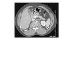 Axial CT Image of Upper Abdomen