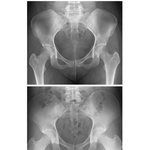 Male and Female Pelvis: Radiographs