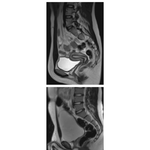 Pelvic Scans: Sagittal T2-Weighted MRIs