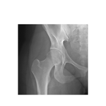 Hip Joint: Anteroposterior Radiograph