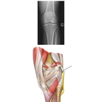 Knee: Anteroposterior Radiograph and Posterior View