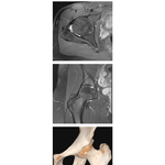 Hip MRI and 3D CT
