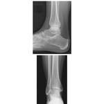 Ankle: Radiographs