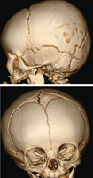 3D Skull Reconstruction CTs