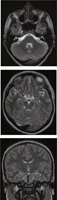 Axial and Coronal MRIs of Brain
