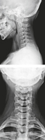 Cervical Spine: Radiographs