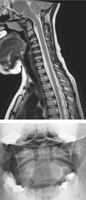 Cervical Spine: MRI and Radiograph