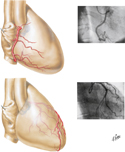 Coronary Arteries: Right Anterolateral Views With Arteriograms