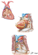 Pericardial Sac and Pericardial Cavity