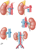 Variations in Renal Artery and Vein