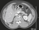 Axial CT Image of Upper Abdomen