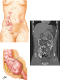 Vermiform Appendix