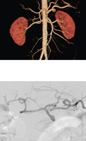 Celiac Arteriogram and CT Angiogram