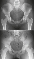 Male and Female Pelvis: Radiographs