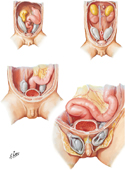 Descent of Testis