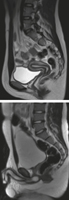 Pelvic Scans: Sagittal T2-Weighted MRIs