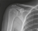 Shoulder: Anteroposterior Radiograph