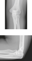 Elbow: Radiographs