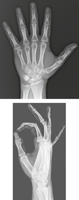 Wrist and Hand: Radiographs